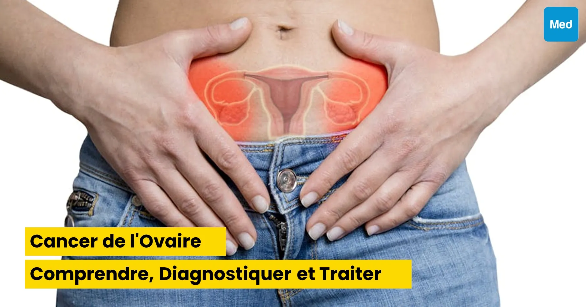 Cancer de l'Ovaire : Comprendre, Diagnostiquer et Traiter
